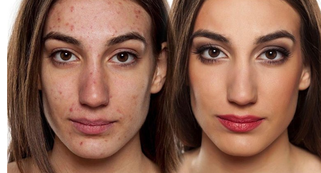 fotografía de una mujer con espinillas en el rostro a la izquierda, y a la derecha su rostro corregido sin espinillas